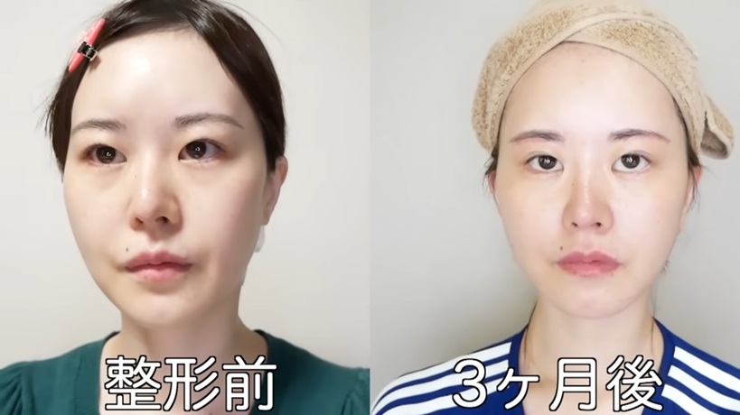 日本人女性の美容整形のビフォーアフター比較画像